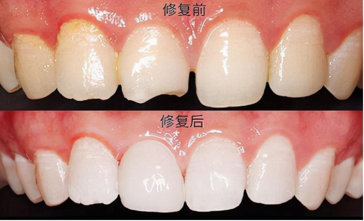明星牙齿背后的故事,璀璨背后的影响与故事