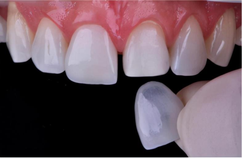 明星牙齿背后的故事,璀璨背后的影响与故事