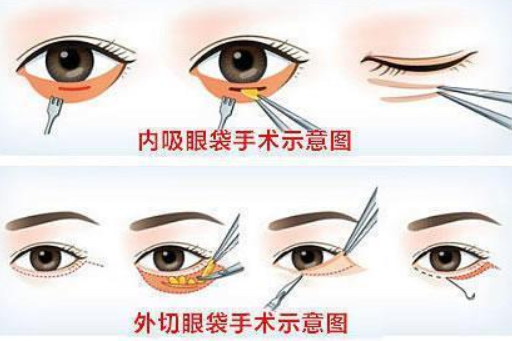 正规医院祛眼袋手术价格详解,全面解析与案例分享