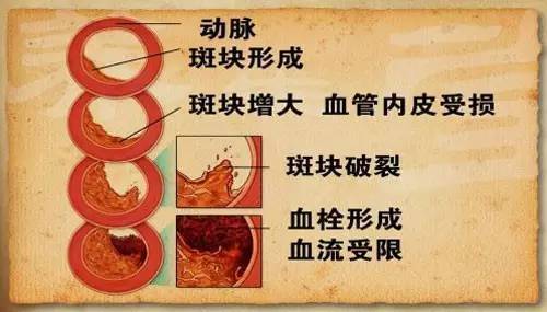 动脉斑块最新治疗方法研究及进展