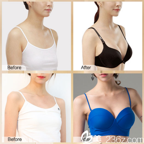 丰胸价格揭秘,历史背景与现代洞察