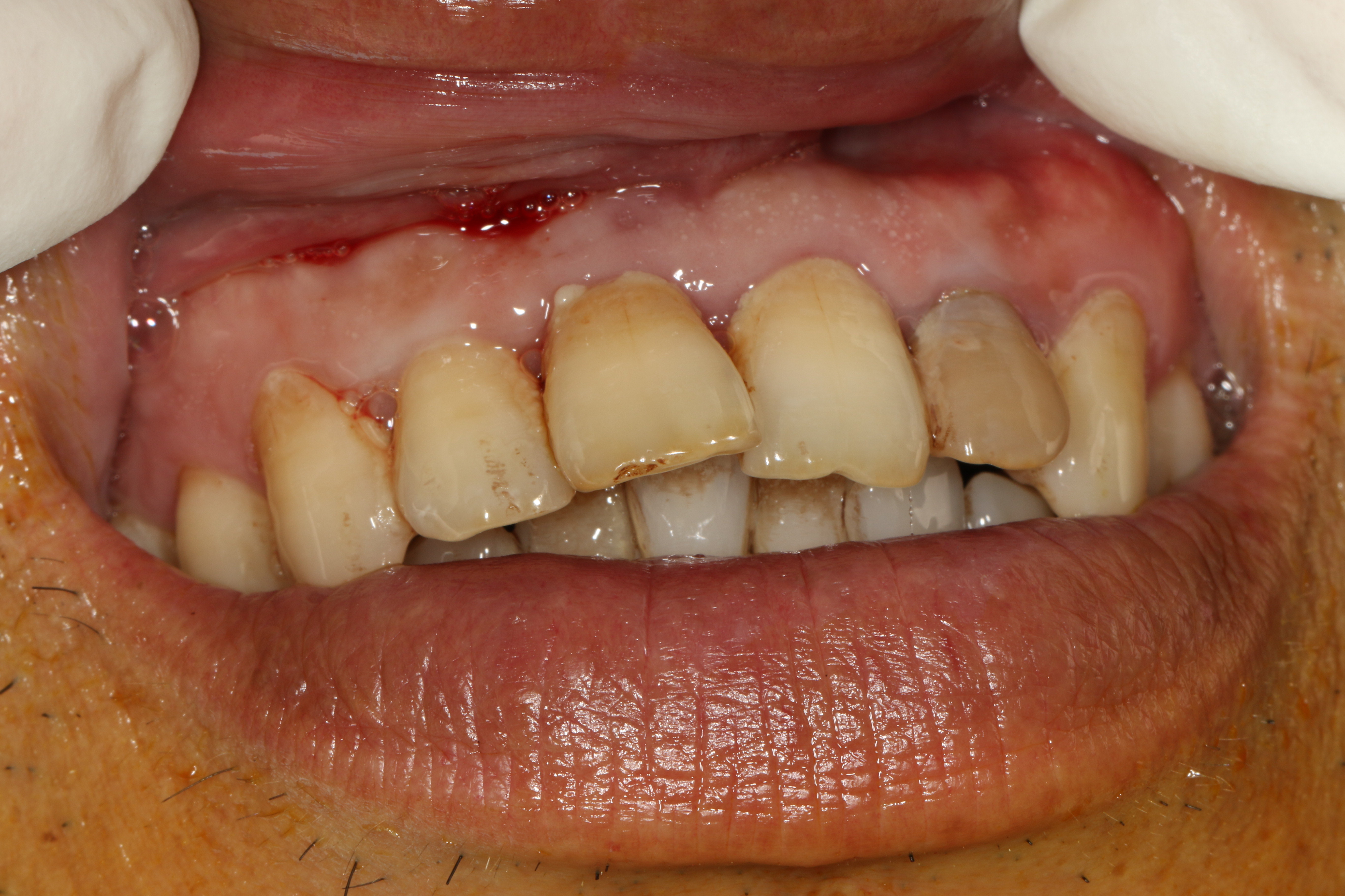 牙再生最新科技突破，重塑笑容的再生之旅??