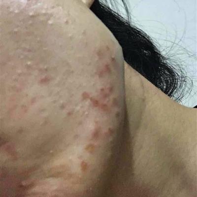 青春痘印,记录友情与时光的痕迹