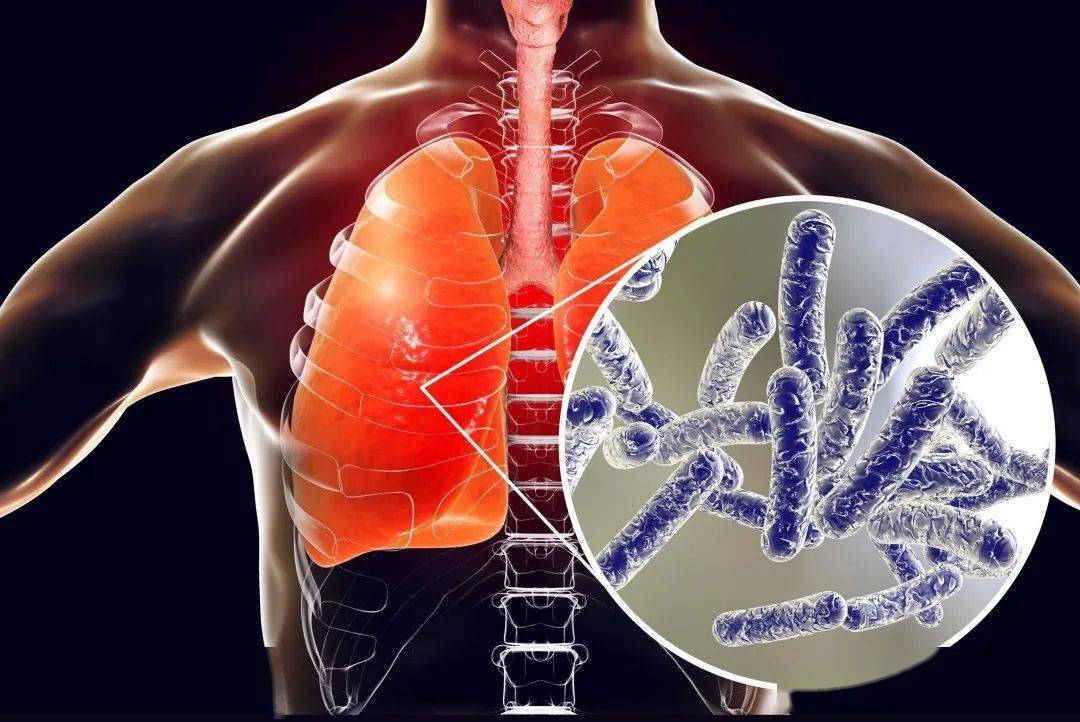 最新肺部感染详解，症状、原因及应对之策