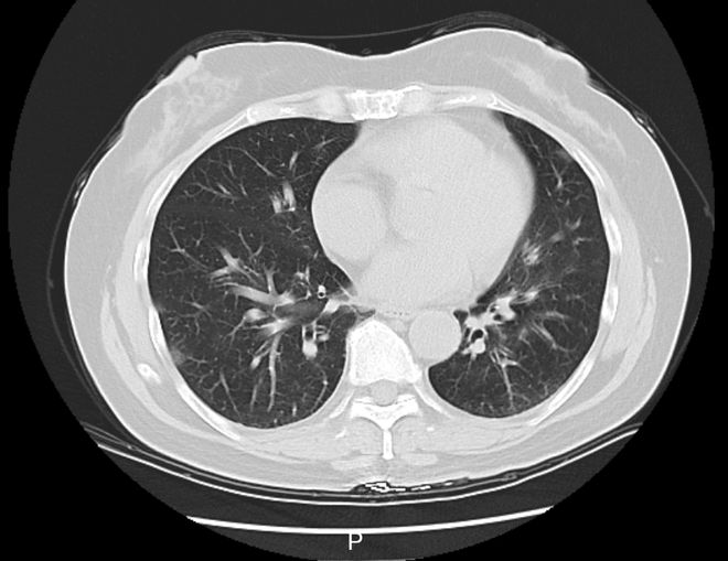最新肺部感染详解,症状、原因及应对之策
